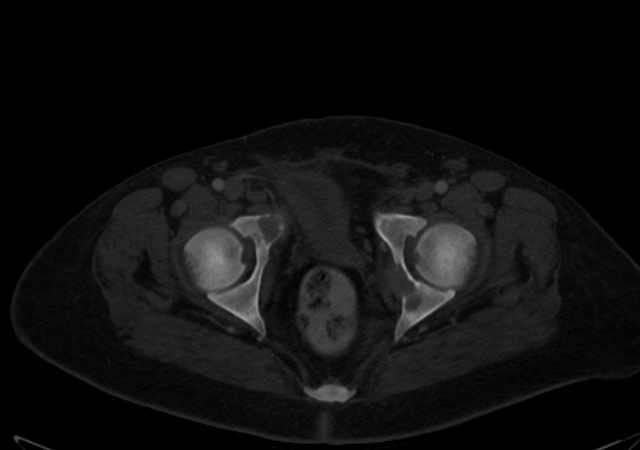 Brown tumors compressing the spinal cord (Radiopaedia 68442-77988 G 120).jpg