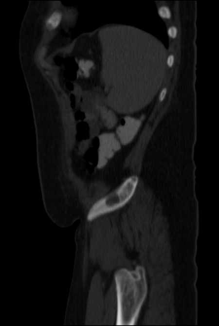Brown tumors compressing the spinal cord (Radiopaedia 68442-77988 H 48).jpg