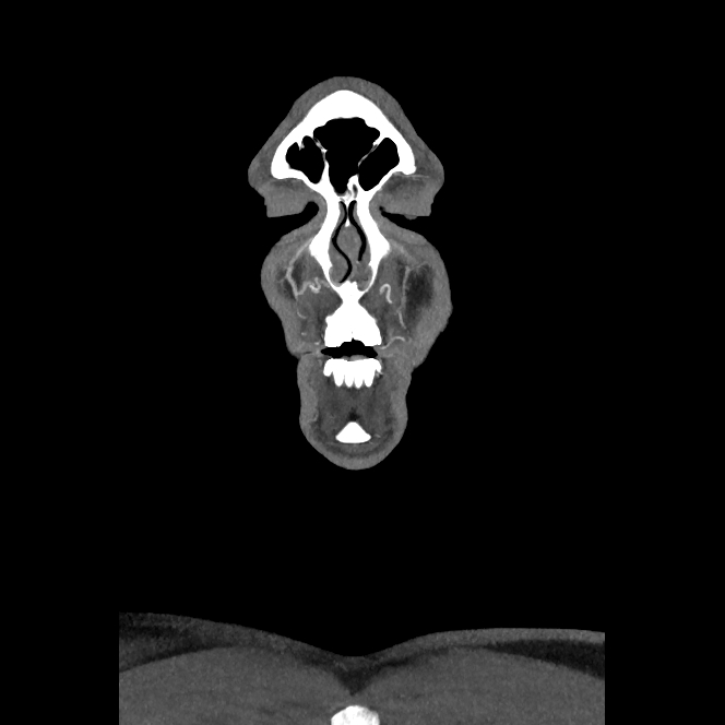 Buccal fat pad arteriovenous malformation (Radiopaedia 70936-81144 B 4).jpg