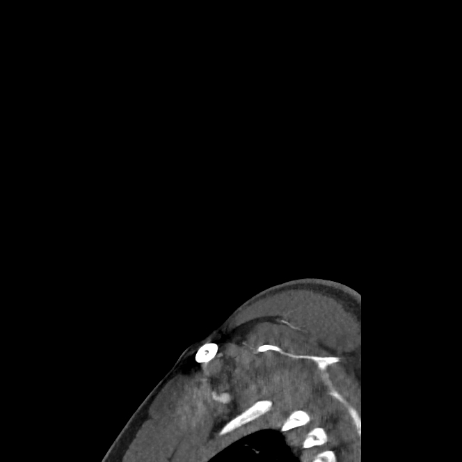 Buccal fat pad arteriovenous malformation (Radiopaedia 70936-81144 C 12).jpg