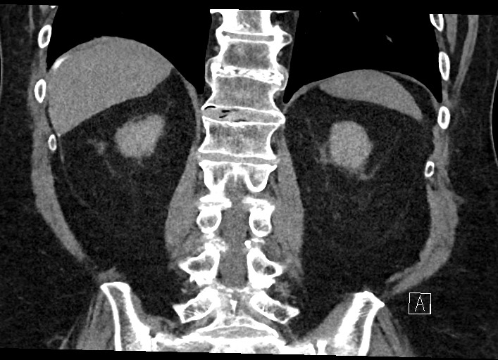 File:Buried bumper syndrome - gastrostomy tube (Radiopaedia 63843-72577 Coronal Inject 101).jpg