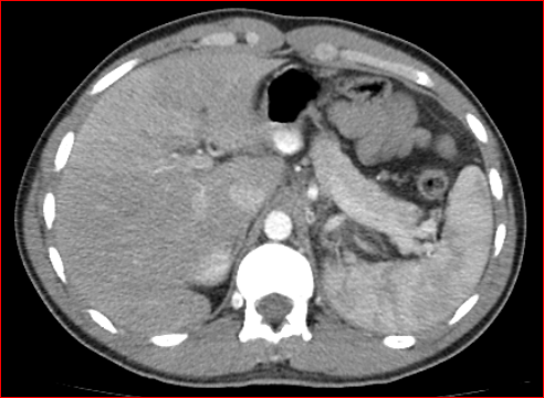 File:Burned-out testicular choriocarcinoma (Radiopaedia 32822-34040 B 1).PNG