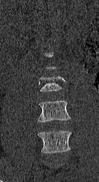 Burst fracture (Radiopaedia 53373-59357 Coronal bone window 10).jpg
