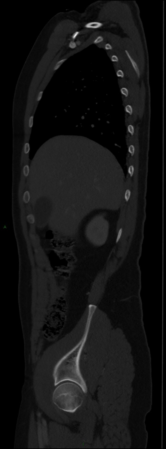 Burst fracture (Radiopaedia 83168-97542 Sagittal bone window 40).jpg