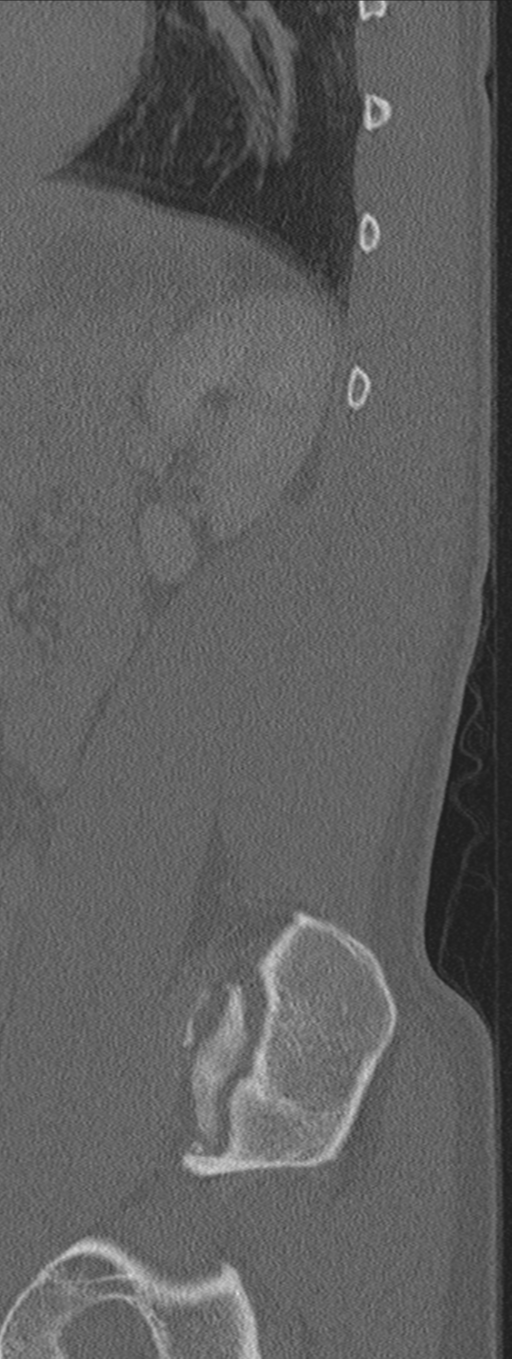 Burst fracture - T12 with conus compression (Radiopaedia 56825-63647 Sagittal bone window 10).png