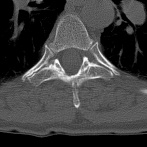Butterfly vertebrae with kyphoscoliosis (Radiopaedia 14257-14133 Axial bone window 4).jpg
