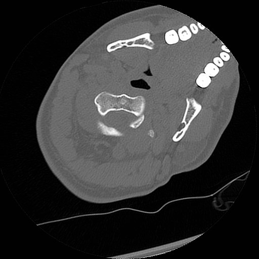 C1-C2 "subluxation" - normal cervical anatomy at maximum head rotation (Radiopaedia 42483-45607 Axial non-contrast 43).jpg