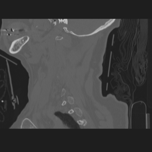 File:C2 fracture (Radiopaedia 34091-35341 Sagittal bone window 18).png