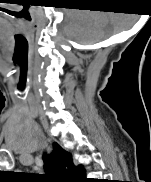 C2 fracture with vertebral artery dissection (Radiopaedia 37378-39199 D 50).png
