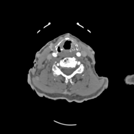 C2 fracture with vertebral artery dissection (Radiopaedia 37378-39200 A 113).png
