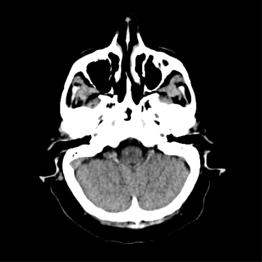 File:CNS Lymphoma (Radiopaedia 44198-47794 Axial non-contrast 8).png
