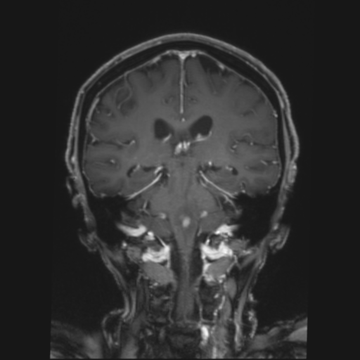 CNS lymphoma with steroid response (Radiopaedia 37980-39921 Coronal T1 C+ 28).png