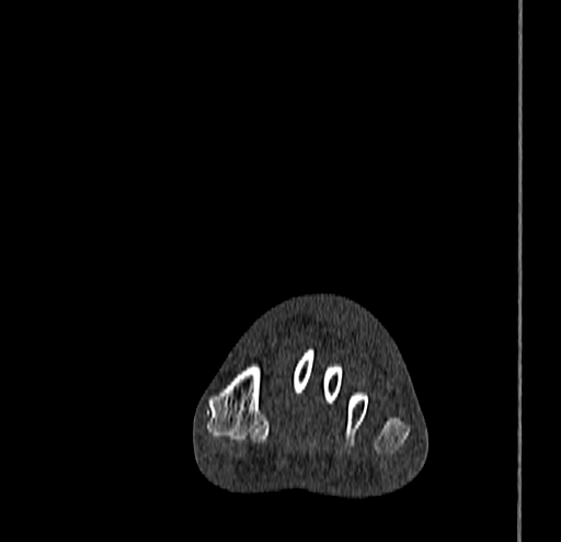 Calcaneal fracture - Sanders type 4 (Radiopaedia 90179-107370 Coronal bone window 29).jpg