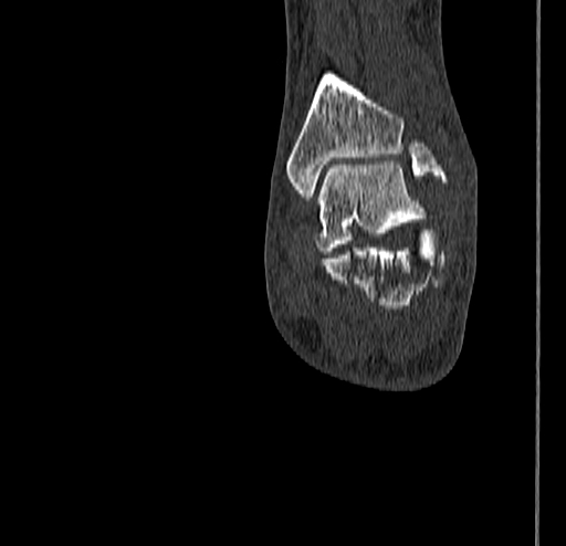 Calcaneal fracture - Sanders type 4 (Radiopaedia 90179-107370 Coronal bone window 68).jpg