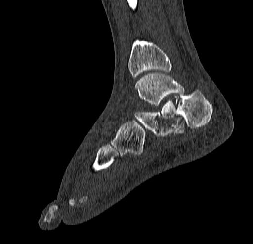 Calcaneal fracture - Sanders type 4 (Radiopaedia 90179-107370 Sagittal bone window 56).jpg