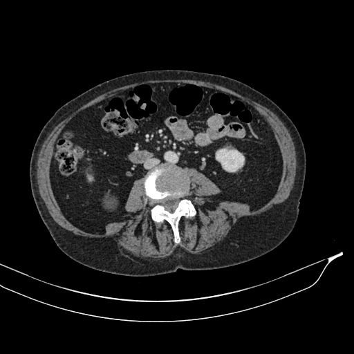 Calcified adrenal glands and Spigelian hernia (Radiopaedia 49741-54988 A 120).jpg