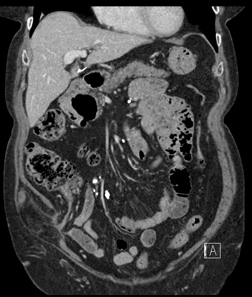 Calcified adrenal glands and Spigelian hernia (Radiopaedia 49741-54988 B 38).jpg
