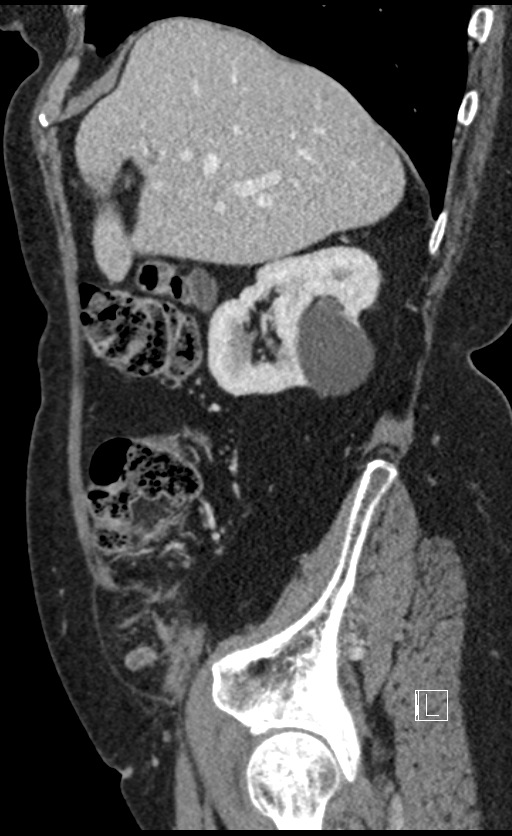 Calcified adrenal glands and Spigelian hernia (Radiopaedia 49741-54988 C 122).jpg