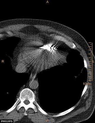 File:Calcified cardiac fibroma (Radiopaedia 39267-41519 Axial non-contrast 12).jpg