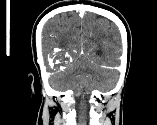 Calcified cerebral hydatid cyst (Radiopaedia 65603-74717 C 55).jpg