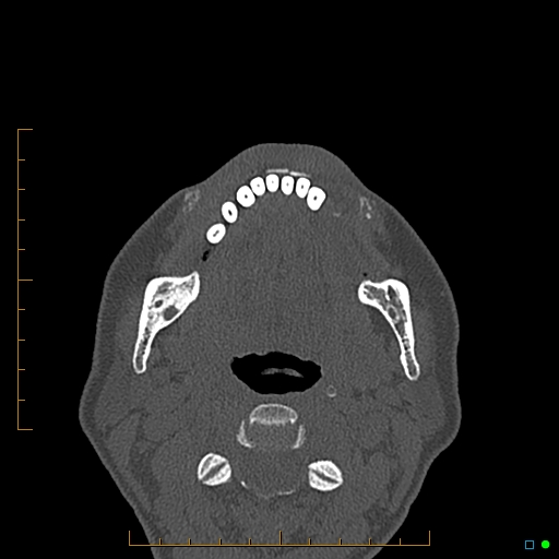 Calcified facial augmentation fillers (Radiopaedia 79514-92679 Axial bone window 123).jpg