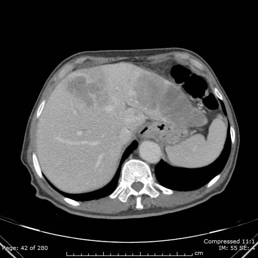 Calcified liver metastases (Radiopaedia 44699-48470 B 15).jpg
