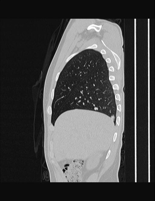Calcifying pulmonary metastases (Radiopaedia 33359-34396 Sagittal lung window 57).jpg