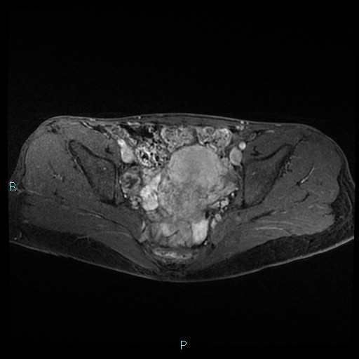 File:Canal of Nuck cyst (Radiopaedia 55074-61448 Axial T1 C+ fat sat 29).jpg
