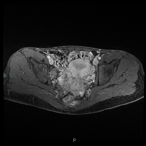 File:Canal of Nuck cyst (Radiopaedia 55074-61448 Axial T1 C+ fat sat 31).jpg