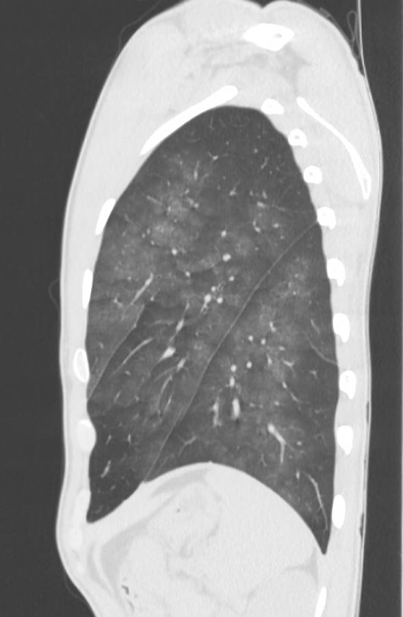 Cannabis-induced diffuse alveolar hemorrhage (Radiopaedia 89834-106946 Sagittal lung window 114).jpg