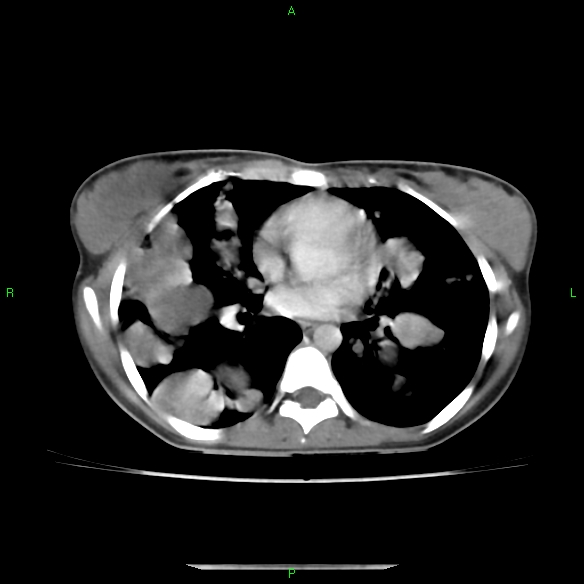 File:Cannon ball metastases - synovial sarcoma (Radiopaedia 26135-26271 C 20).jpg