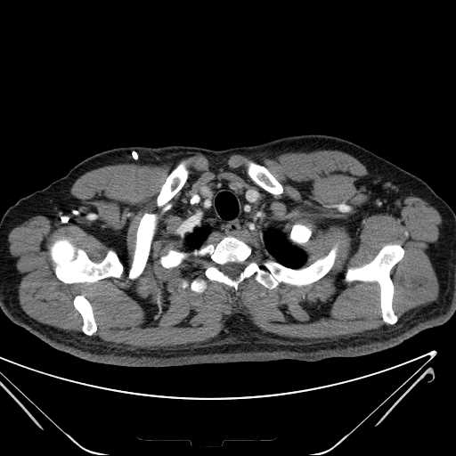 File:Cannonball pulmonary metastases (Radiopaedia 67684-77101 D 21).jpg