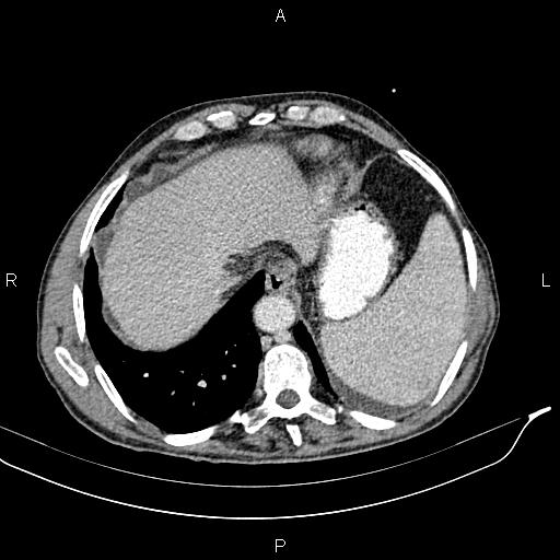 File:Caput medusae sign - portal hypertension (Radiopaedia 64007-72759 A 7).jpg