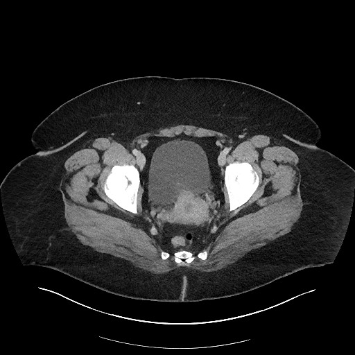 File:Carcinoid tumor - terminal ileum (Radiopaedia 60931-68739 A 123).jpg