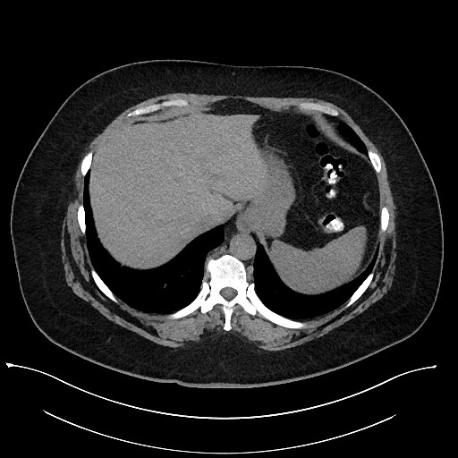 Carcinoid tumor - terminal ileum (Radiopaedia 60931-68740 Axial non-contrast 10).jpg