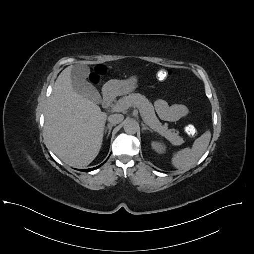 Carcinoid tumor - terminal ileum (Radiopaedia 60931-68740 Axial non-contrast 26).jpg