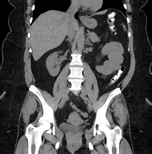 Carcinoid tumor - terminal ileum (Radiopaedia 60931-68740 Coronal non-contrast 59).jpg