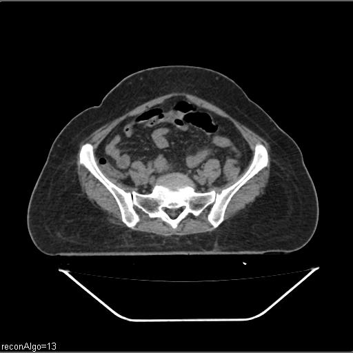 File:Carcinoma cervix- brachytherapy applicator (Radiopaedia 33135-34173 Axial non-contrast 7).jpg