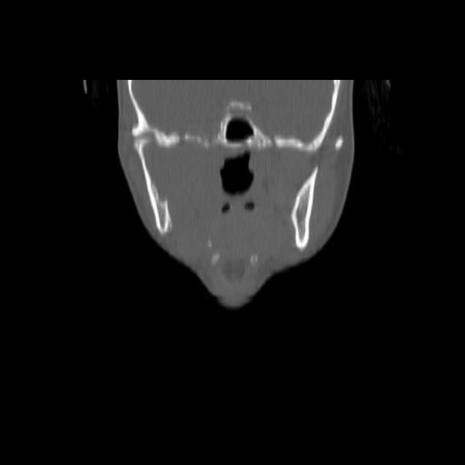 Carcinoma of the maxillary antrum (Radiopaedia 53805-59888 Coronal bone window 71).jpg