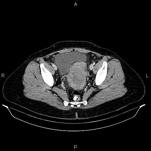Carcinoma of uterine cervix (Radiopaedia 85861-101700 A 69).jpg