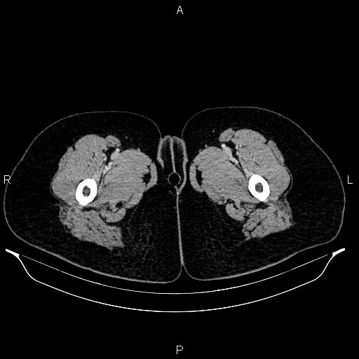 File:Carcinoma of uterine cervix (Radiopaedia 85861-101700 A 84).jpg