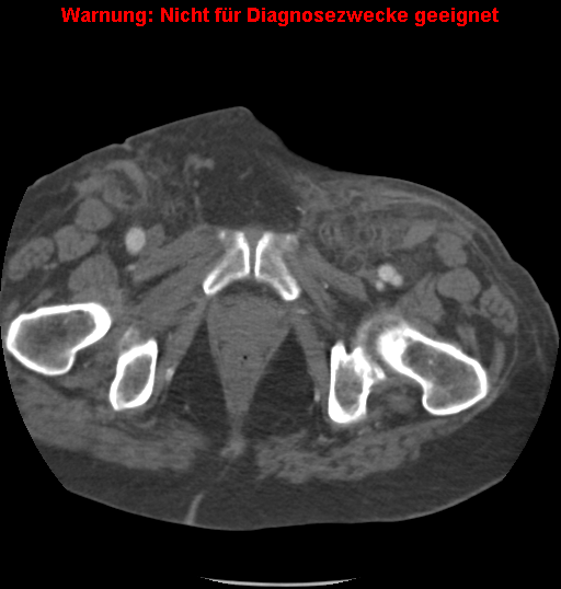 File:Cardiac perforation following transcatheter aortic valve implantation (Radiopaedia 23714-23863 B 12).png