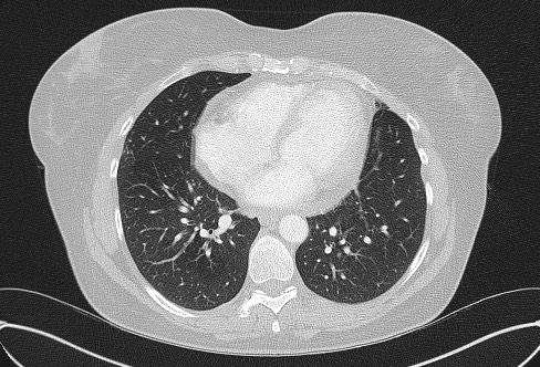 Cardiac sarcoidosis (Radiopaedia 74548-85534 Axial lung window 59).jpg