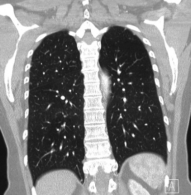 Cardiac sarcoidosis (Radiopaedia 74548-85534 Coronal lung window 51).jpg