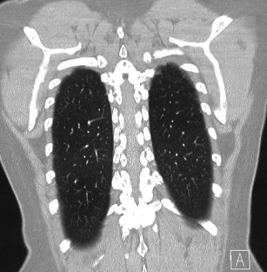 File:Cardiac sarcoidosis (Radiopaedia 74548-85534 Coronal lung window 59).jpg