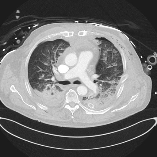 Cardiac trauma (Radiopaedia 32874-33858 Axial lung window 23).jpg