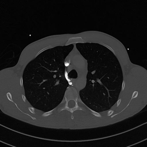 Cardiac tumor - undifferentiated pleomorphic sarcoma (Radiopaedia 45844-50134 Axial bone window 23).png