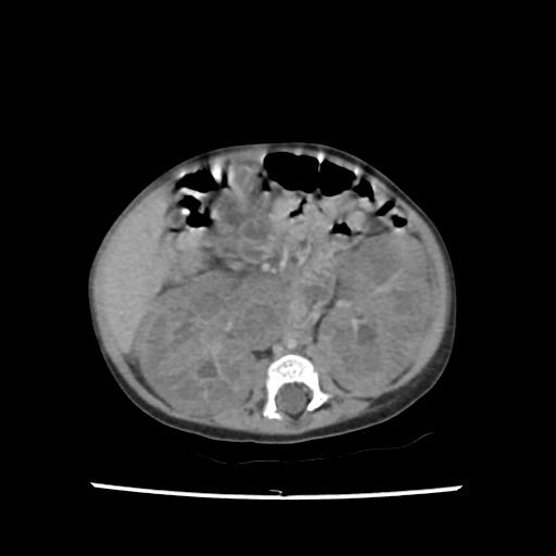 Caroli disease with autosomal recessive polycystic kidney disease (ARPKD) (Radiopaedia 89651-106703 B 121).jpg
