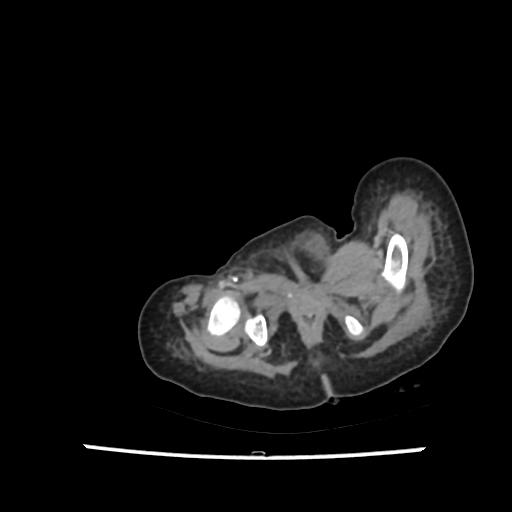 File:Caroli disease with autosomal recessive polycystic kidney disease (ARPKD) (Radiopaedia 89651-106703 B 238).jpg