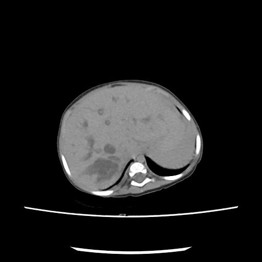Caroli disease with autosomal recessive polycystic kidney disease (ARPKD) (Radiopaedia 89651-106703 E 37).jpg